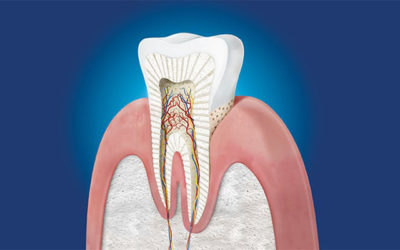 Come aiutare il dente a ripararsi naturalmente?