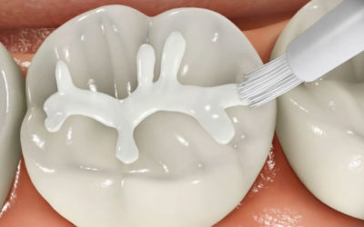 Cosa succede quando arriva il primo molare permanente?