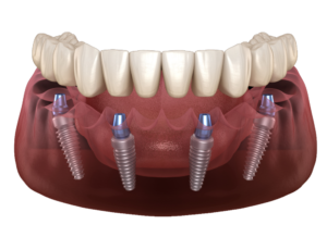 Impianti dentali