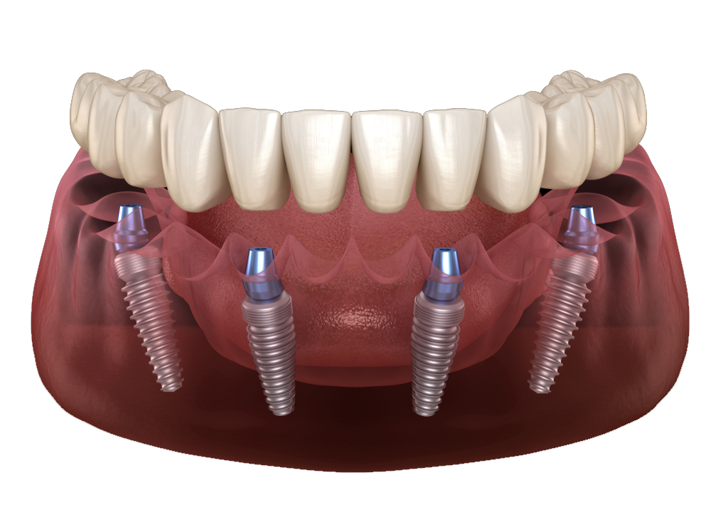 Impianti dentali