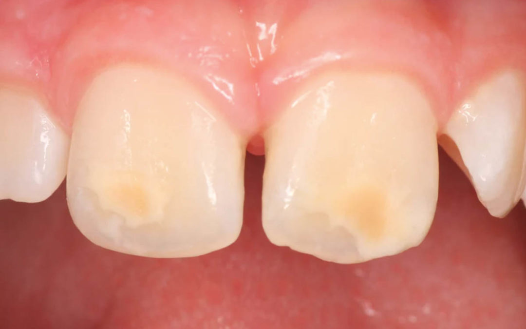 Difetti dello smalto sui denti dei bambini