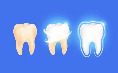 Remineralizzanti per lo smalto dei denti