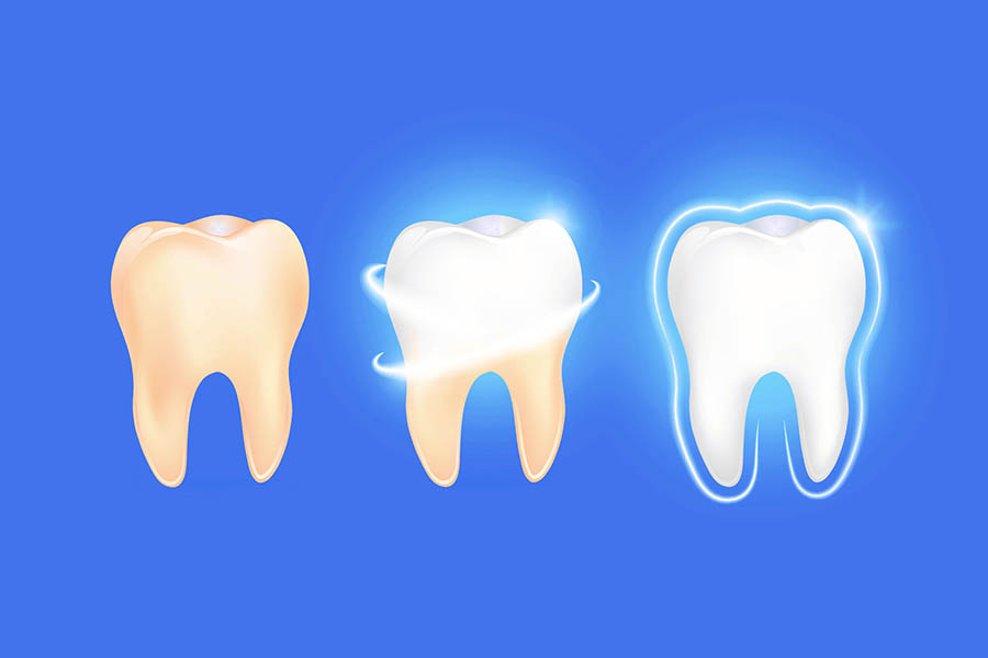 Remineralizzanti per lo smalto dei denti