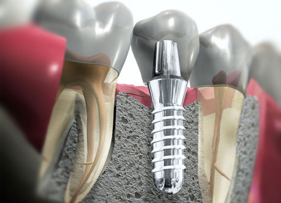 Terapia impianti dentali Terapia impianti dentali