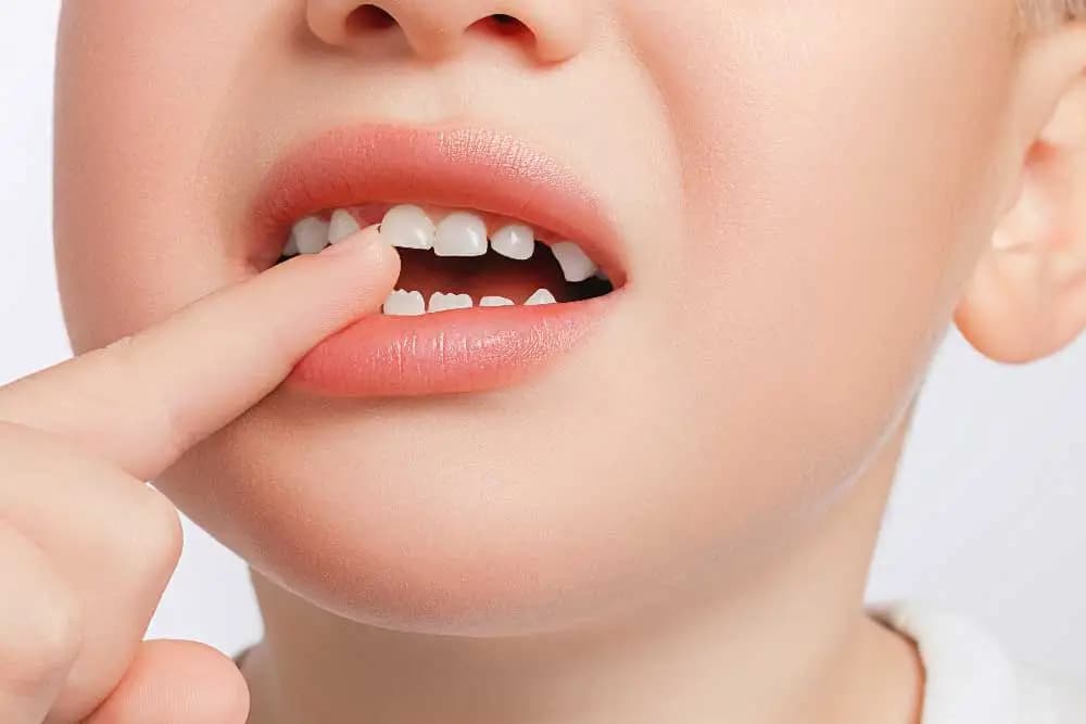 La permuta dentaria nei bambini: di cosa parliamo?