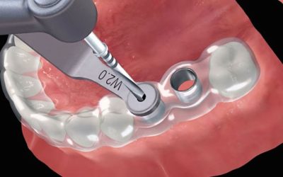 Impianti dentali: cos’è la chirurgia guidata?