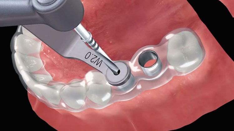 Impianti dentali: cos’è la chirurgia guidata?