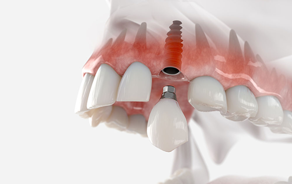 Come mantenere sani i tuoi impianti dentali?